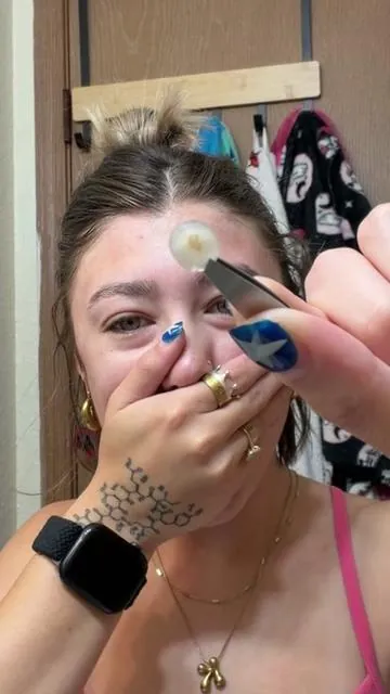 These were so fun to use 🤣 #pimplepatches #gunk #satisfying #pimple #woah 