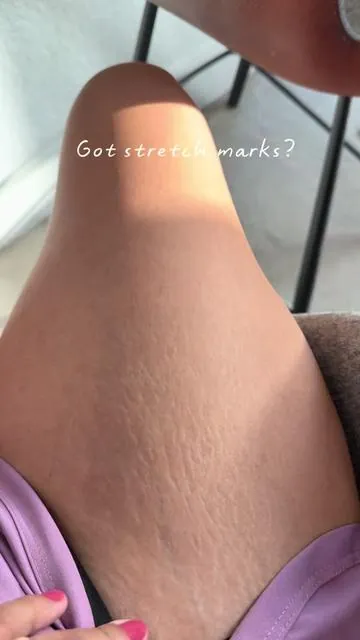 Easy there stretch marks  #stretchmarks #looseskin #stretchmarkcream  Disclaimer: Results may vary. This product is not intended to diagnose, treat, cure, or prevent any disease. Consult your healthcare provider before use, especially if pregnant, nursing, or taking medication. 
