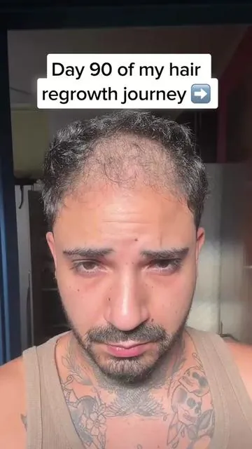 He was 90 days away from shaving it all off. Here's what happened instead. Same guy. Same hairline. Completely different result. He'd been scrolling past the same ads for weeks. Another hair product. Another promise. He almost kept scrolling. But something about this one caught his attention. No pills. No prescriptions. No flying to Turkey and sitting through painful procedures. No spending $5,000 hoping for the best. He'd already tried the usual stuff. Gimmicky shampoos that did nothing. Minoxidil knockoffs that washed off before they could do anything. He was done trusting products that didn't make sense. So when he saw something that actually explained how it worked, he stopped scrolling. Most products sit on top of your scalp. They never reach where the problem actually starts. This one uses microinfusion to push the serum 300% deeper into the follicle. Natural DHT blockers like ginseng, ginger root, and licorice extract. The stuff that actually targets the root cause. He ordered it. No expectations. Just curiosity. Day one, he took a photo. Hairline receding. Crown thinning. The usual. First few weeks, not much. He almost gave up. Then his shedding slowed. Then his hair stopped looking see through. Then people started asking what he was doing differently. Day 90, he took another photo. Same lighting. Same angle. He said he looked 10 years younger. No surgery. No side effects. No complicated routine. Just consistency and the right approach. He's not the first guy who almost shaved it off. He won't be the last. But he's proof that trying one more time can actually be worth it. 70% off right now. 120 day money back guarantee if it doesn't work. Link's below if you're where he was. #alphainfuse #hairloss #hairtok #hairlossjourney #hairtransformation