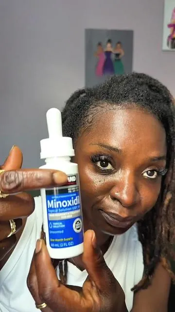 #hairthinningsolutions  #minoxidilresult 