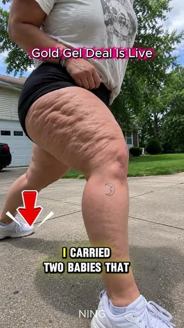 I frickn love this shit for my cellulite and stretch marks. #SummerVibes #cellulite #TikTokShopDealsforYouDays #SummerWins #tiktokshopsummersale