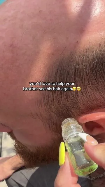 Do you know someone with male pattern baldness? @Alphainfuse microneedling kit is by far the best men's hair growth kit I've seen! but of course, these are just my opinions always do your research. This is not medical advice. Results may vary. This is an affiliate video. I may earn a commission #malehairloss #malepatternbaldness #menshairgrowth #menshairloss #hairgrowth 