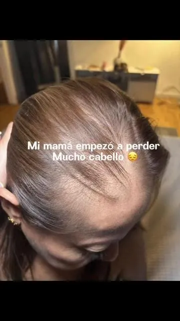 Disclaimer results may vary #hairgrowth #caidadecabello #crecimientodelcabello #cabellolargo #hairvitamins 