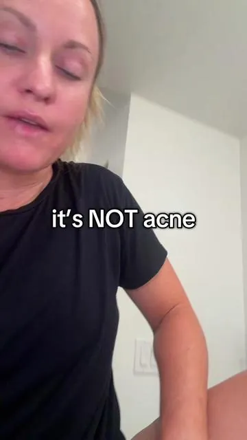Nothing, I hate more than cysts, boils, and flareups 🤬 #hidradenitissuppurativa #cysts #boils #salicylic #tiktokshopcreatorpicks  