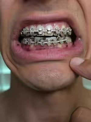 It was bad 😭 #gaptaincrunch #bracesoff #fyp #TikTokShopCreatorPicks #braces
