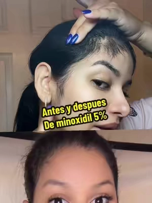 Antes y después de minoxidil 5% lo uso en las cejas y cabello para engrosar el cabello y hacerlo crecer comprobado que funciona #minoxidil #minoxidilresult #hairgrowth #crecimientodelcabello #hairloss 
