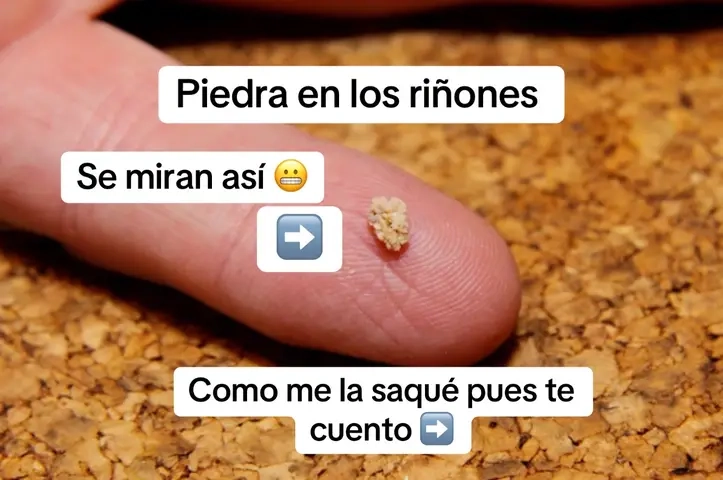 #piedraenlosriñones #kidneystone #tiktokshopcreatorpicks #gallagher 
