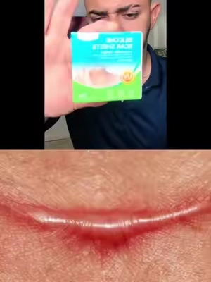 Cinta de silicona para cicatrices #cicatriz #cicatrizacion #heridas #sirugia #tiktokshop 