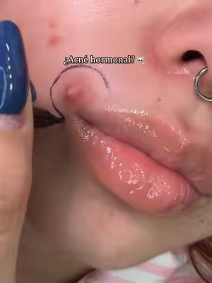 Fed up with persistent hormonal breakouts? Watch this 7-day result #tiktokshopsummersale #acnetreatment #acne #clearskin #drleodryinglotion 
