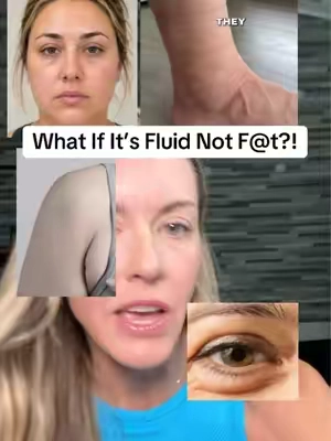 The lymphatic system doesn’t get the attention it deserves…people don’t realize how important it is for removing waste, immune health, circulation, & absorption of healthy fats. When we don’t support it that’s when we see armpit b00bs, sock marks, puffy face, and saggy eyebags. @Clean Nutra made it easy and put all the best lymphatic support  supps in one liquid dropper. #eyebags #cleannutra #inflammation #lymphaticdrainage #ad Not medical advice. Always discuss your health concerns/supplements with your doctor. 