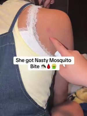 But bite thing insect bites 