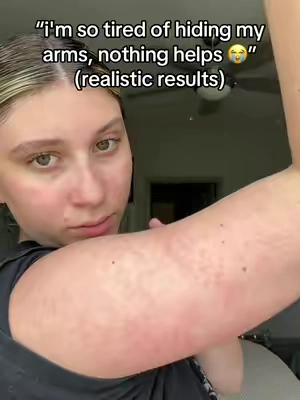 finally after years i found something working to clear my KP 🥲 #KP #strawberryskin #skintransformation 