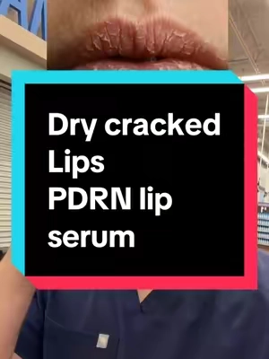 If you have cracked dry lips, put down the Carmax and actually use something that’s going to help moisturize and get you the dewy hydrated lips. @Dr.Rejuall lip serum is a game changer for your lips by adding PDRN and hibiscus enzymes to hydrate and exfoliate your lips leaving them soft, hydrated, and smooth. Just a quick disclaimer: While I’m a licensed pharmacist, the advice I share here is for general educational purposes only. Always check in with your own doctor or healthcare provider for personal medical advice.  #drrejuall #chappedlips #drylips #lipserum #lips 