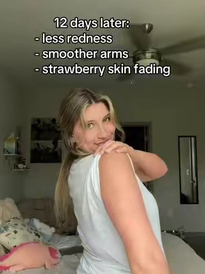 finally something working to clear my KP 🥲 #KP #strawberryskin #skintransformation 
