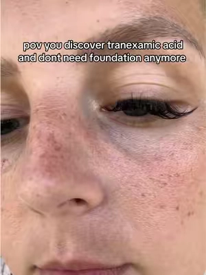 Replying to @Jdevon710 hyperpigmentation, and melasma had me feeling ugly. Like i needed foundation… tranexamic acid and niacinamide are my heros