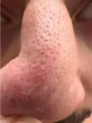 no more blackheads @ilso US #ilso #pores #sebumsoftener #koreanskincare #tiktokshopcreatorpicks 