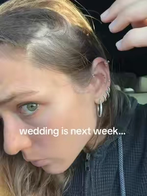 of course I’d be balding before the wedding 🫪 @VT Cosmetics US #haircareroutine #hairloss #balding #vtcosmetics #hairgrowth 
