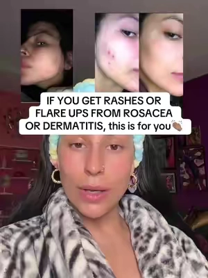My holy grail!!!!! #rash #dermatitis #rosacea #flareup #skin 
