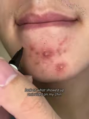 look at what showed up uninvited on my chin@Dr.Leo-USA #weeklydealsn #summerwins #acne #blackhead #oilyskin 