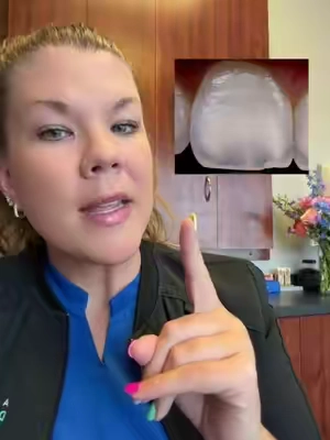 Nano hydroxyapatite is going to help whiten, desensitize, and remineralize! @Ceelike Oral Care @CEELIKE Global @CEELIKE Global @CEELIKE & MSDRWIKEY Oral Care #nanohydroxyapetite #nanohydroxyapatitetoothpaste #remineralizeyourteeth #mouthology #cavityreversal 