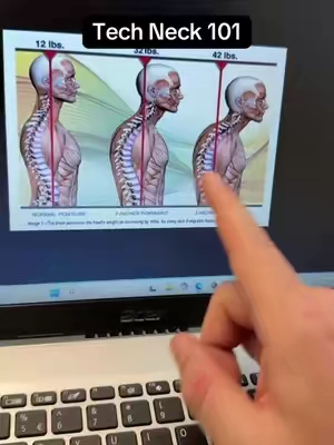 If you’ve been struggling with neck pain, stiffness, or headaches you may need to address your pillow. Poor posture over a long period of time may contribute to tech neck. #techneck #neckpain #posturecorrection #cervicalpillow #neckpillow 