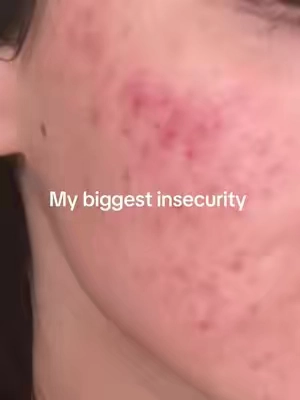 #acne #skincare #skin #acneproneskin #viral 
