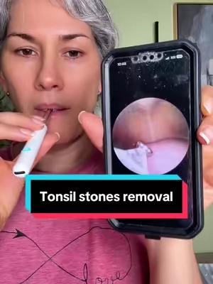 #tiktokshopsummersale #summerfinds #tonsilstonesremoval #malaliento 
