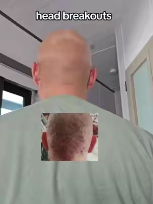 back of head breakout .  . results vary  body wash