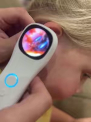 I love being able to see now! #ear #earwax #earcamera #eartubes #earinfection 