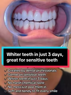 No filter and these are my real teeth. As a dental hygienist of 11 years, I feel so confident recommending these whitening trays to my patients & friends because I use them every 3 months, I should add I have sensitive teeth and these give me no issues. I’m a 2 cup a day coffee lover, so I make sure I keep up with my whitening.  #whiterteeth #teethwhitening #brightsmile #whitesmile #teethcare 