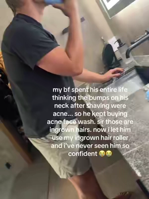 help this man 😭  #ingrownhair #shavingbumps #ingrownhairs #bfrelatable #couplegoals      