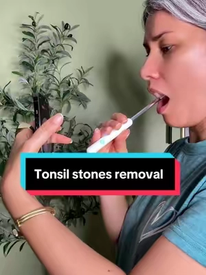 #summerfinds #tiktokshopsummersale #tonsilstonesremoval #malaliento 