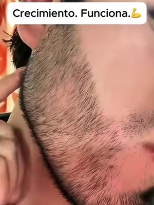 Esto es lo único que funciona en mi barba. Funciona de maravilla.🫡🫡🧔#beardgrowth #beardcare #hairgrowth #beardmen #beards 