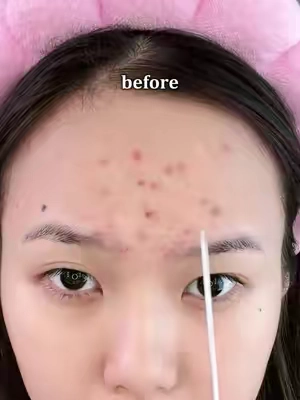 It's not greasy, doesn't clog pores — but somehow, zits fade and redness goes down. Not because it's magic, because it lets your skin heal itself.💚🤍#summerwins #acne #acnetreatment #drleo #glassskin 