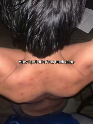 POV: You finally found something that helped your back acne. 🤝 #backacne #acne #bodywash #skincare #acnetips     