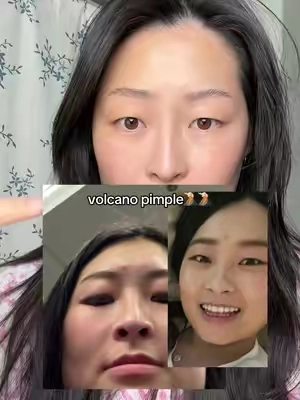 Deep exfoliating is how you remove those stubborn volcano#pimple #acne #pimples #koreanskincare #tonerpad 