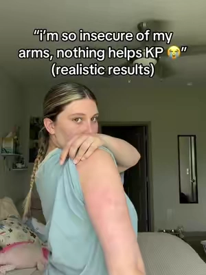 i never thought my KP would go away 🥲 #KP #strawberryskin #skintransformation #bodybumps 