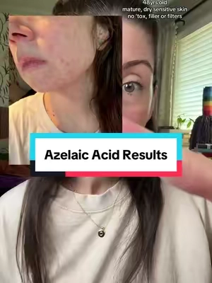 Here are my results from using azelaic acid every morning on my over 40 mature, sensitive dry skin. Adding this azelaic acid from Anubis is the only change I’ve made in my skincare routine. I apply it every morning after I wash and exfoliate my face then I continue with the rest of my skin care routine. I am thrilled with results! Individual results may vary. @Anua Store US #anua #azelaicacid #over40 #perimenopause 
