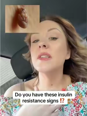 Did you know that skin tags were a sign of insulin resistance? #bloodsugarbalance #sugarcravings #a1c #cleannutra #insulinsensitivity  Disclaimer: results vary by individual, not medical advice 