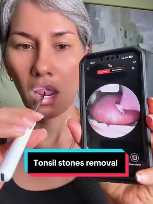 #tonsilstonesremoval #TikTokshopbacktoschool #malaliento 