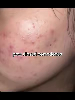 #medicubeporepads #tonerpads #cloggedpores #clearskinroutine #skincareroutine 