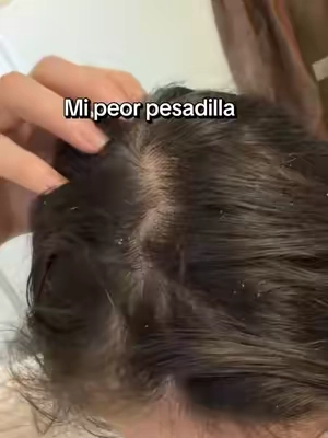 Así es como te vas librar totalmente de la CASPA #blackfriday #tiktokshopcreatorpicks #caspa #cerave #shampooparacaspa @CeraVe 