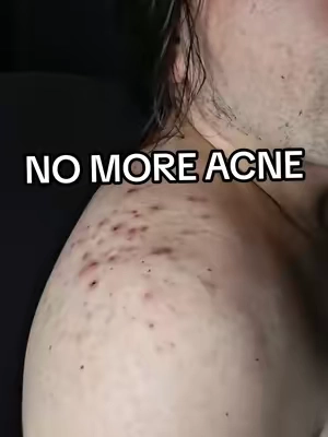 ngl elite body acne cleanser  #somebymi #acne #bodyacne #clearskin #bodywash 