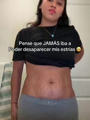 #stretchmarks #estrias #flacidezabdominal #estriasembarazo #SuperBrandDay  Disclaimer: This is not a professional advice. Results may vary. This is based on my personal experience  Only in United States  Ad @Gopure 