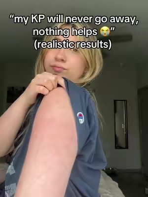 still can’t believe there’s finally something that works 🥲 #KP #strawberryskin #skintransformation #keratosispilaris 