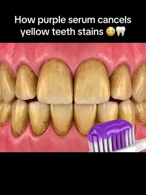 The results are actually insane… 😳 🦷 ‼️ #yellowteeth #teethwhitening #teethcare #oralcare #v34colourcorrector 