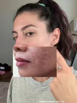 Get rid of stubborn hyperpigmentation with the @Eqqualberry vitamin illuminating duo ✨ #eqqualberry  #PostAcneMarks #UnevenSkinTone #DarkSpotCare #SkincareRoutine