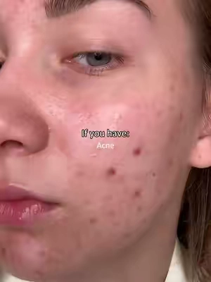 If you have: Acne Skin texture Enlarged pores Clogged pores Blackheads Use these@Dr.Leo-USA #weeklydeals #summerwins #acne #blackhead #salicylicacid 