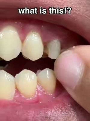 How did this happen!? 😳 #gaptaincrunch #fyp #teethwhitening #viral #ad 