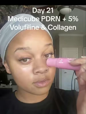 Day 21 of using Medicube pink bomb stick under my eyes and I think I see a little bit of a difference. What do y’all think? #medicube #pdrn #collagen #filler #skincareroutine 
